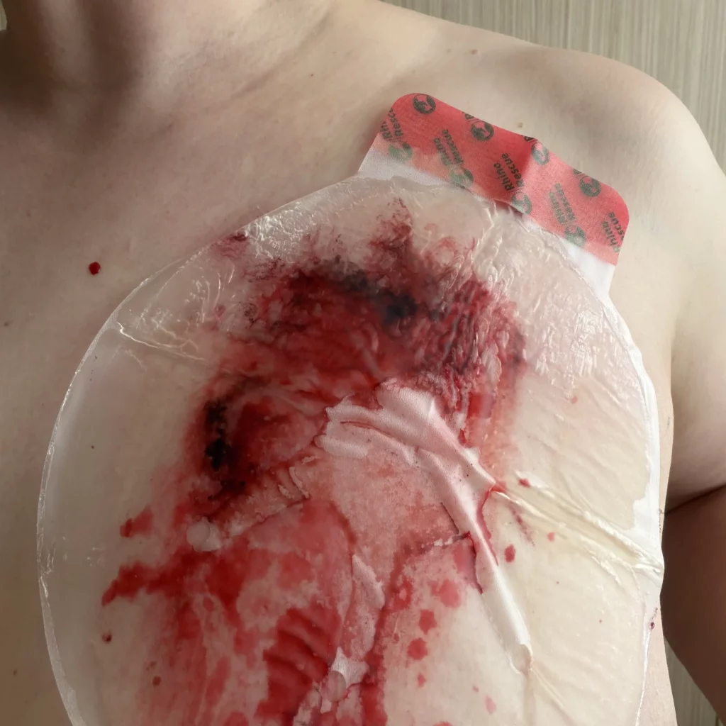 Použití hrudního krytí Rhino Rescue